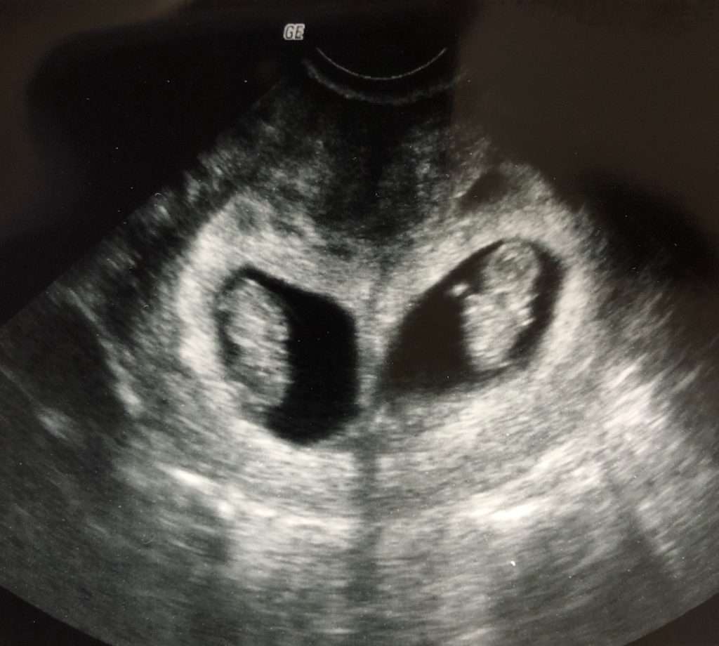 Twins ultrasound